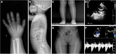 Case Report: Two different acromelic dysplasia phenotypes in a Chinese family caused by a missense mutation in FBN1 and a literature review